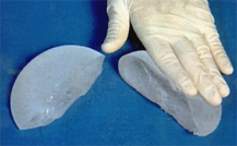 Implante mamario de gel de silicona cohesivo